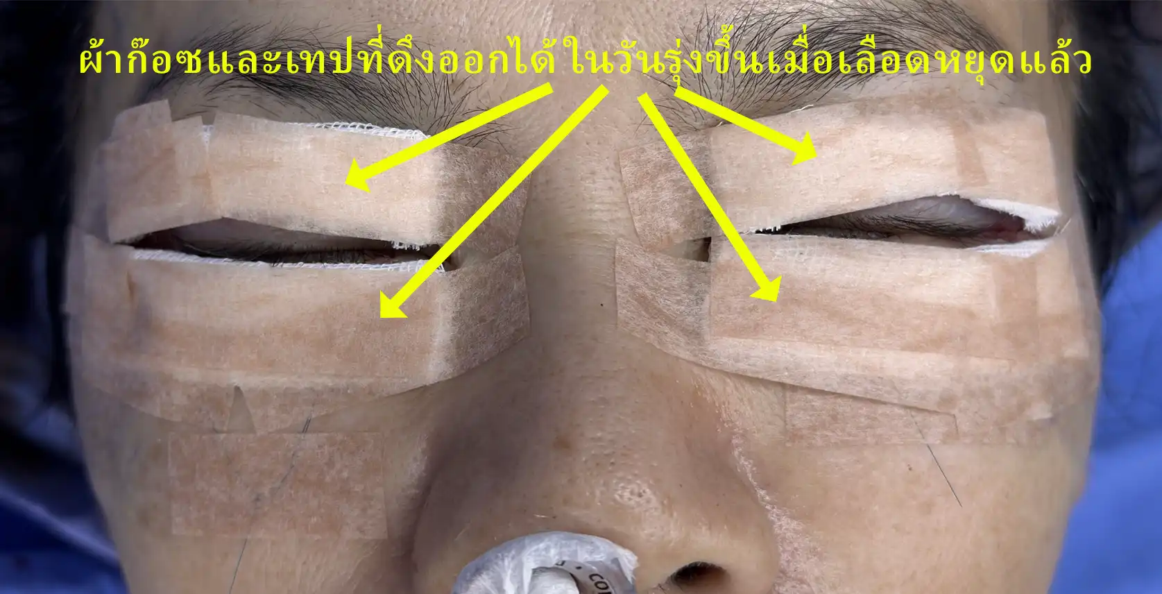 อย่าดึงปลายไหมยื่นยาวออกมาและถูกยึดด้วยเทปออก ส่วนเทปและก๊อซที่ปิดคลุมแผล แกะทิ้งได้ในวันรุ่งขึ้น เพราะเลือดหยุดแล้ว