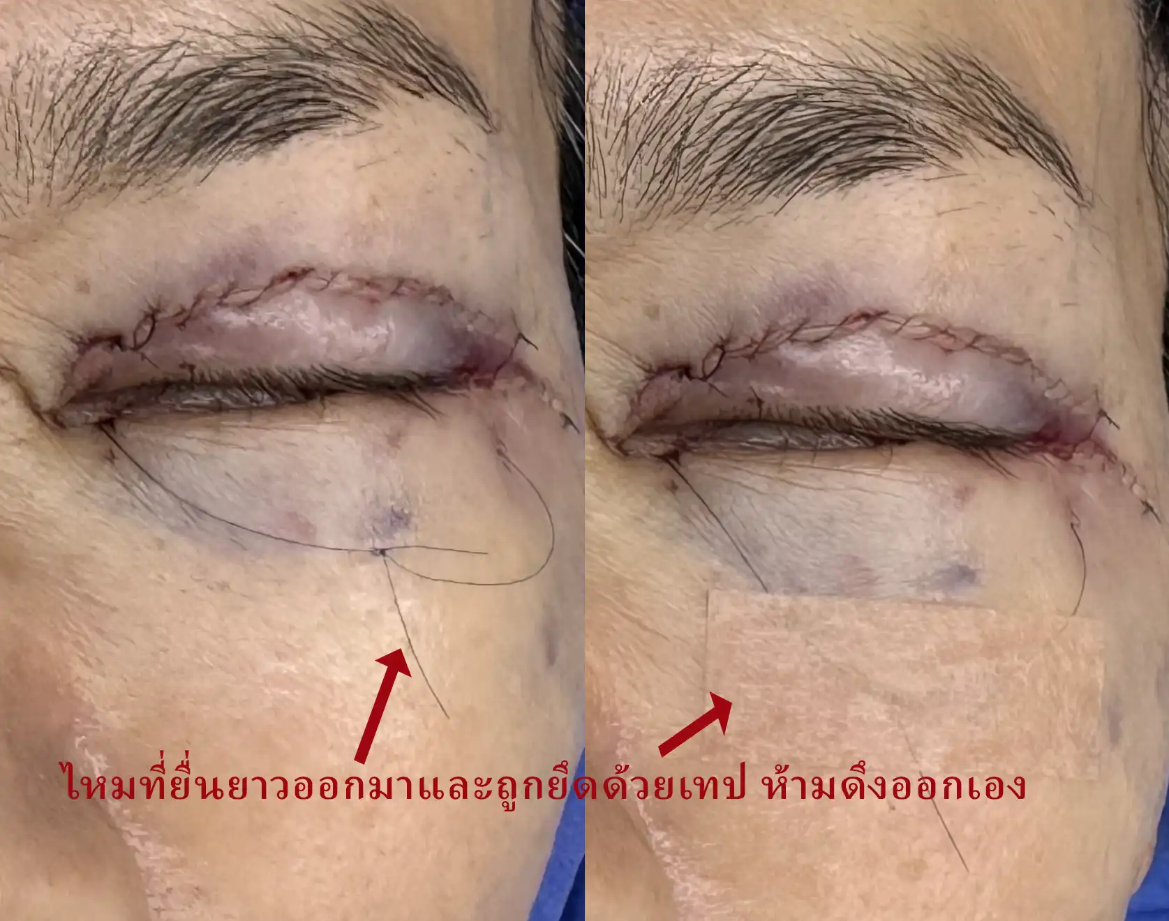 อย่าดึงปลายไหมยื่นยาวออกมาและถูกยึดด้วยเทปออก ส่วนเทปและก๊อซที่ปิดคลุมแผล แกะทิ้งได้ในวันรุ่งขึ้น เพราะเลือดหยุดแล้ว