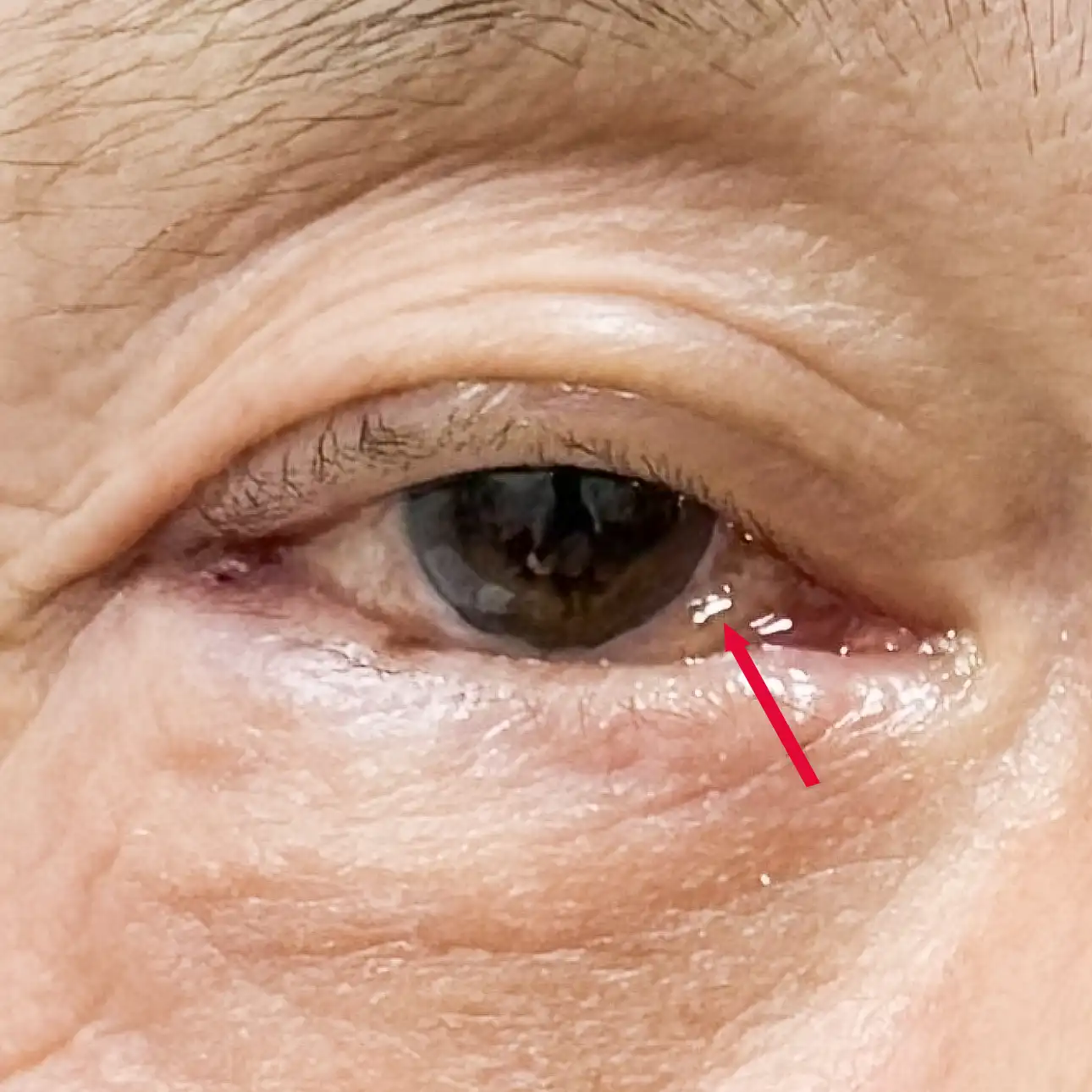 ภายหลังการผ่าตัดตาล่างโดยลงแผลทางด้านใน ผู้ป่วยบางรายอาจมีการบวมของเยื่อบุตาขาว (chemosis) ได้ บางรายก็น้อย บางรายก็มาก