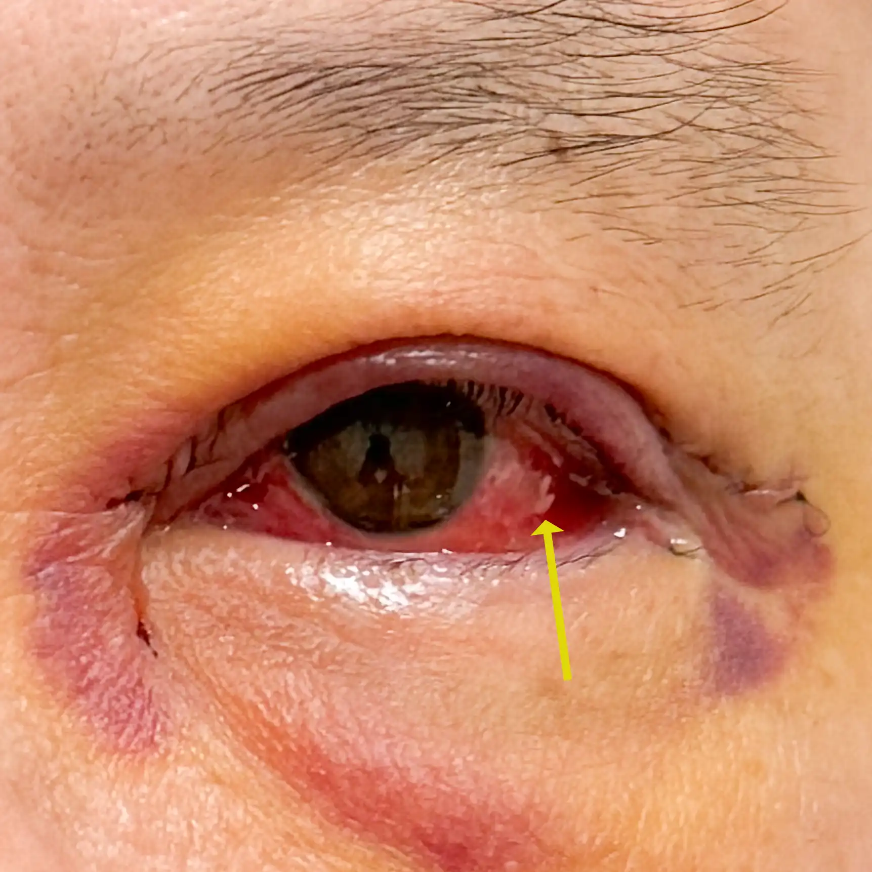 ภายหลังการผ่าตัดตาล่างโดยลงแผลทางด้านใน ผู้ป่วยบางรายอาจมีการบวมของเยื่อบุตาขาว (chemosis) ได้ บางรายก็น้อย บางรายก็มาก