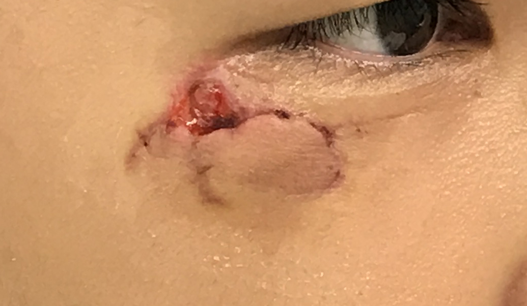 A lower eyelid laceration. After 5 days, a skilled plastic surgeon can still achieve a good result with suturing.