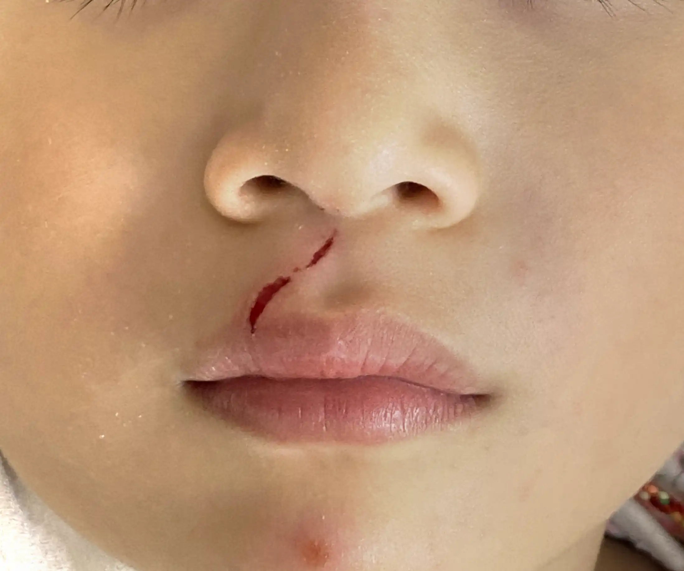 An upper lip laceration, a few hours after injury.